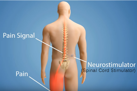 Spinal Cord Stimulator Is Good For Chronic Pain